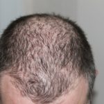 hair loss